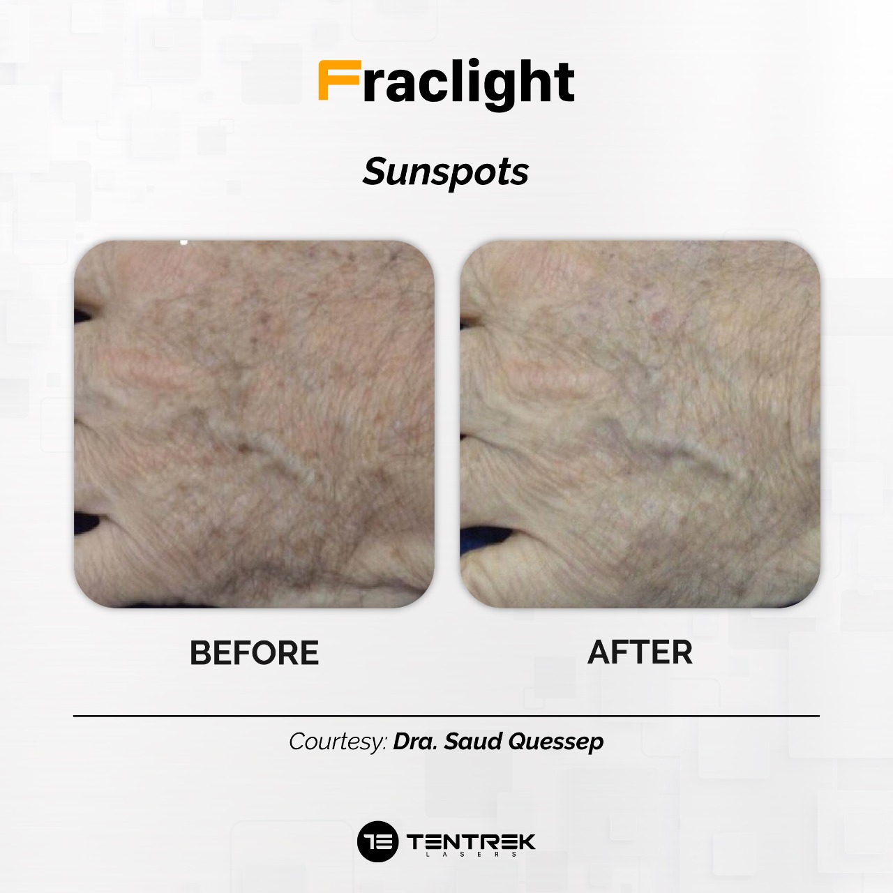 Resultados de tratamiento Fraclight IPL en Medellín