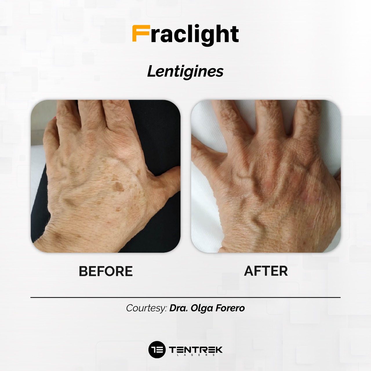 Tratamiento Fraclight en Medellín