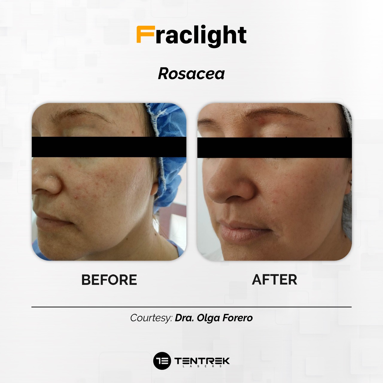 Tratamiento Fraclight en Medellín