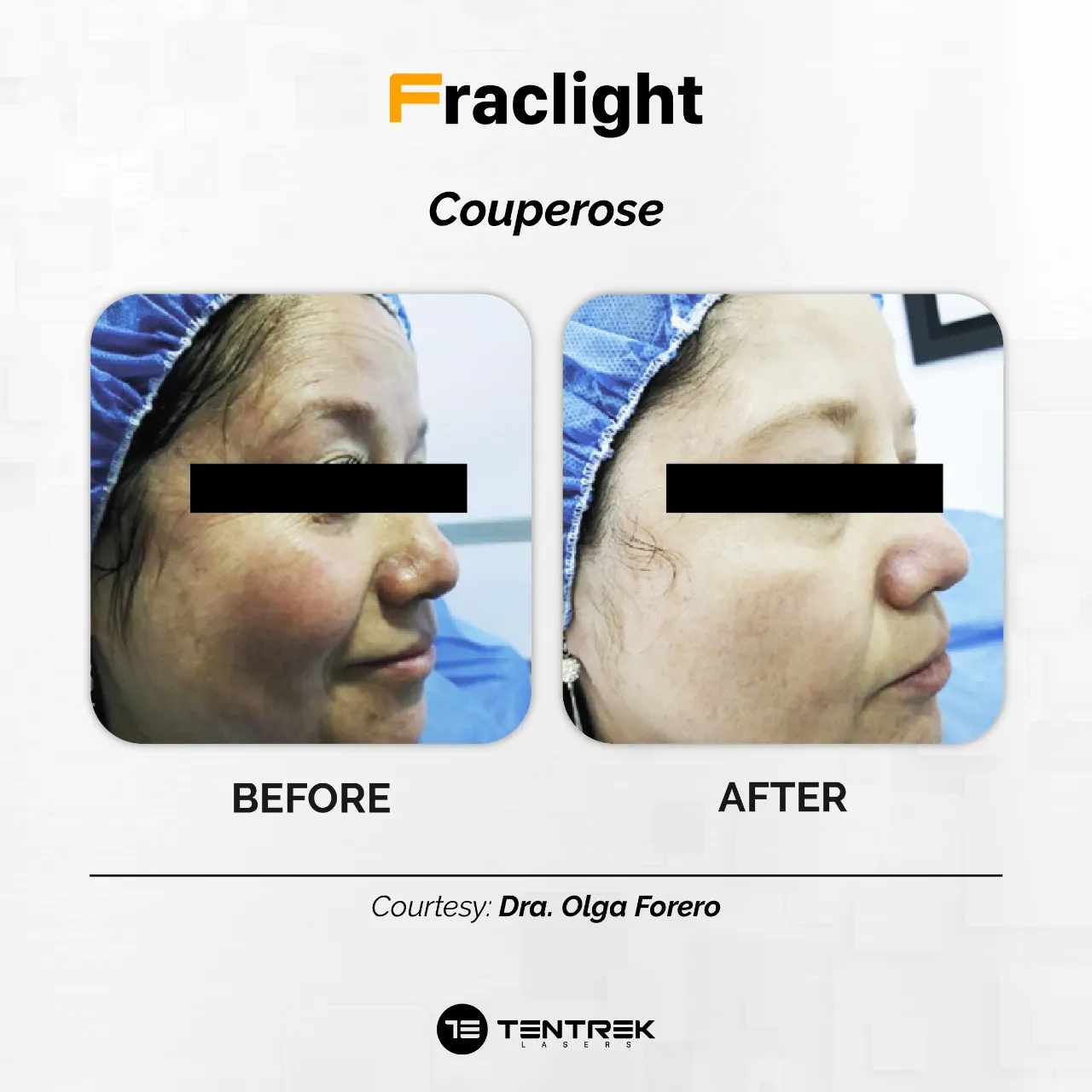 Tratamiento Fraclight en Medellín