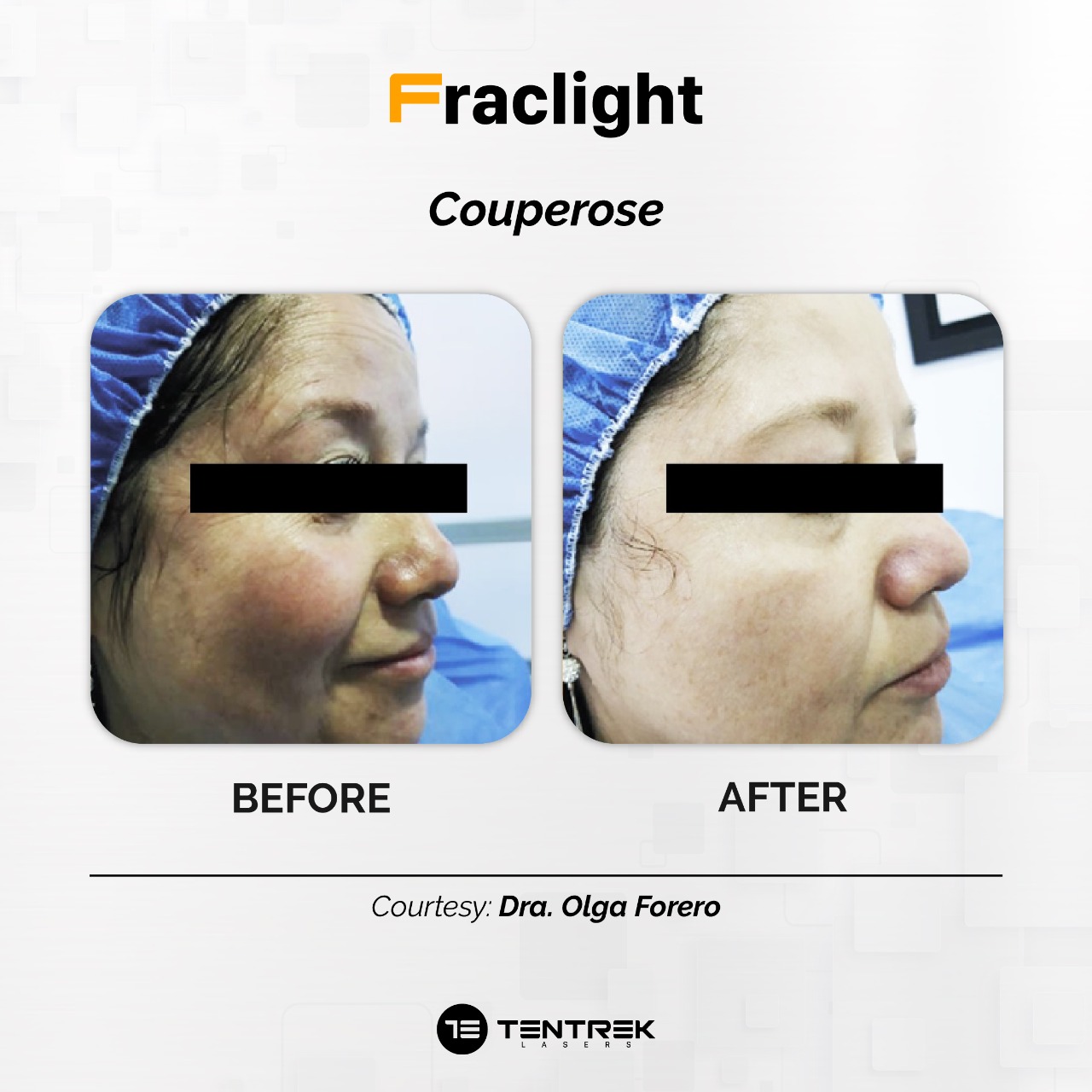 Tratamiento Fraclight en Medellín