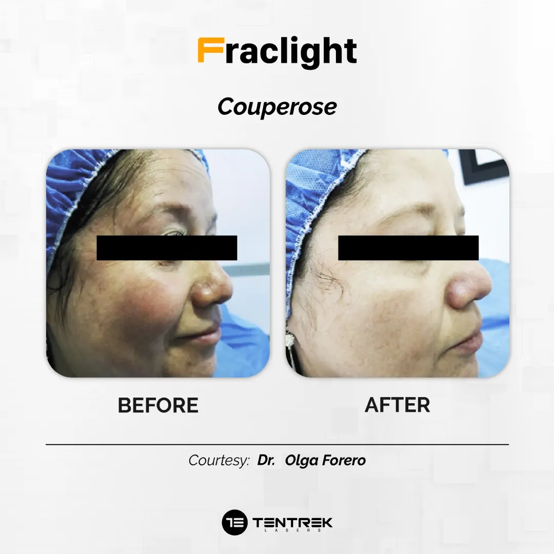 Tratamiento Fraclight en Medellín