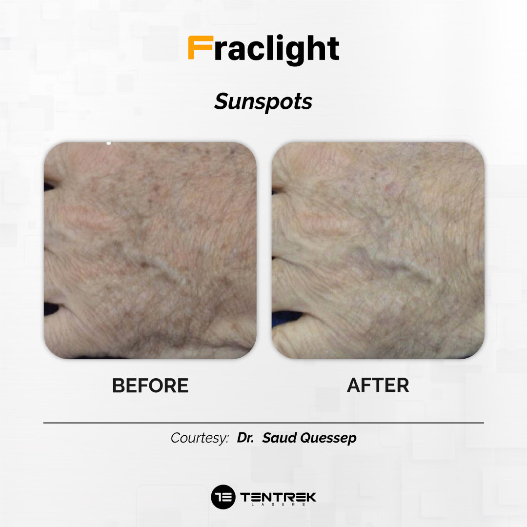 Tratamiento Fraclight en Medellín