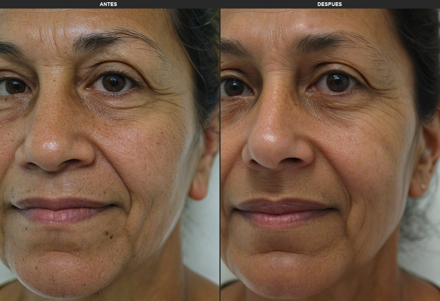 Resultados Fraclight - Antes y Después