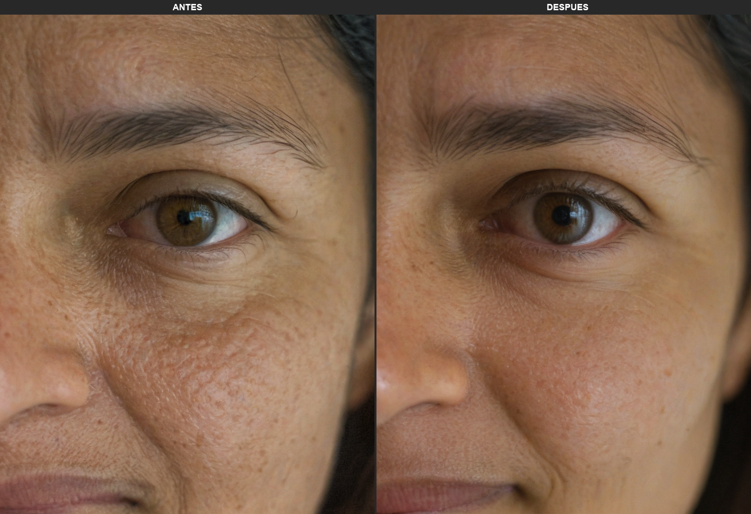 Resultados Fraclight - Antes y Después