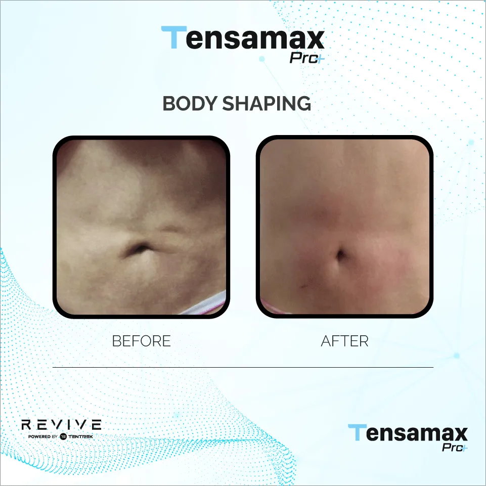 Tensamax result for skin laxity - case