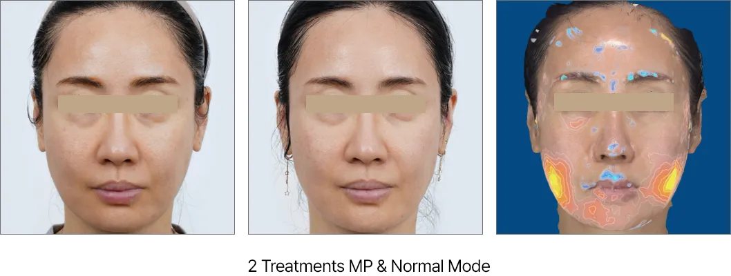 Resultados Ultraformer - Antes y Después