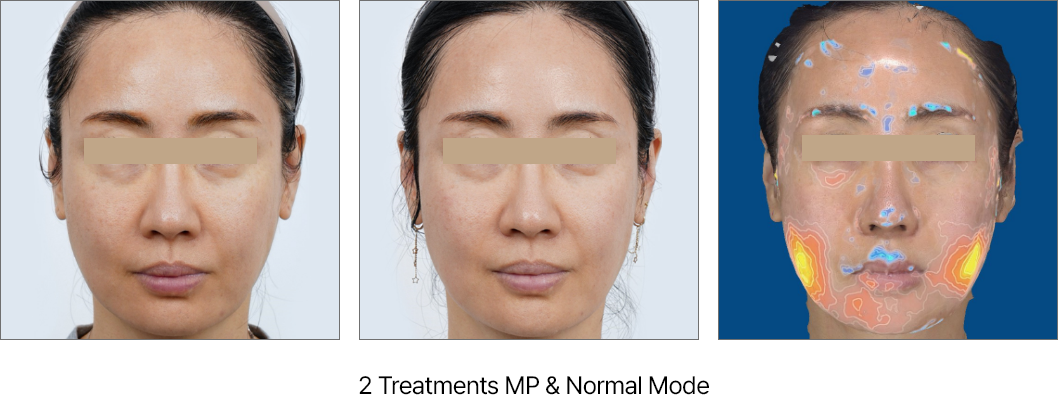 Resultados Ultraformer - Antes y Después