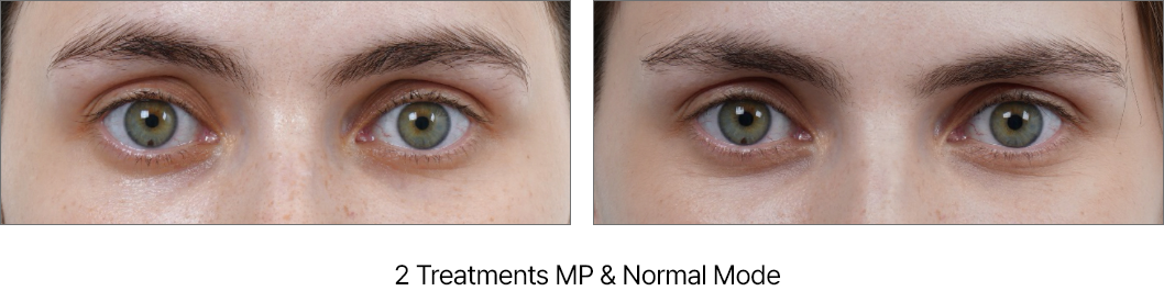 Resultados Ultraformer - Antes y Después