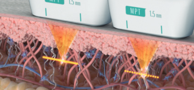 Ultraformer facial treatment step 1
