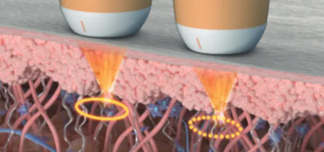 Ultraformer application on the face