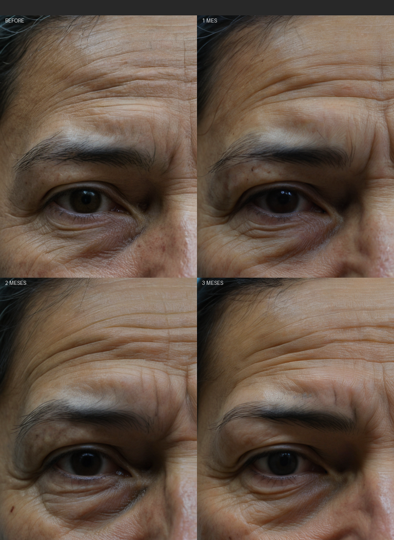Resultados Ultraformer - Antes y Después