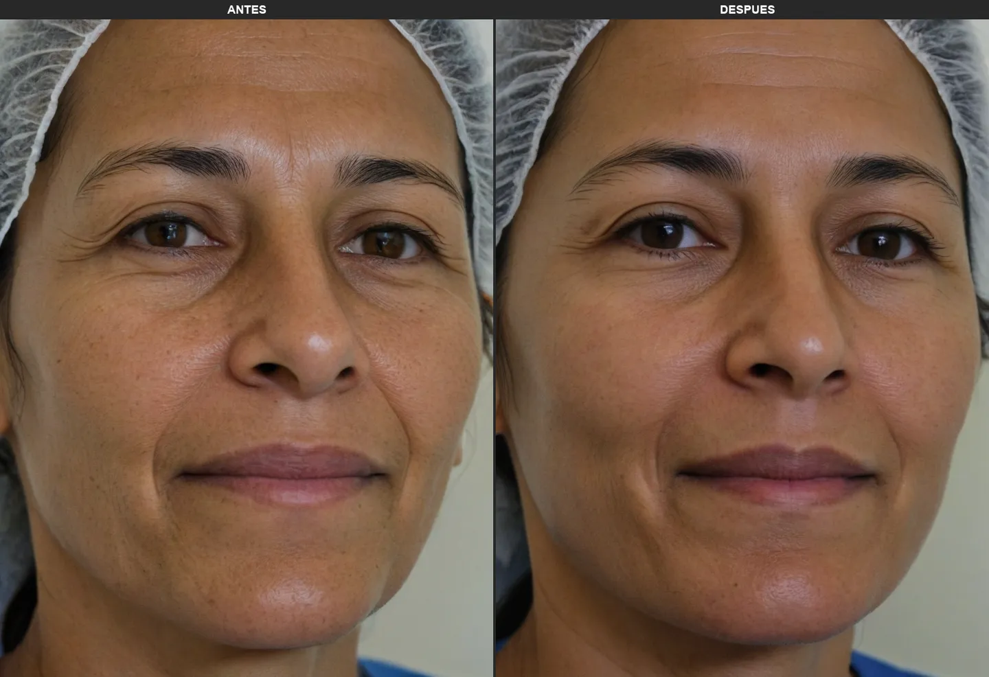 Resultados Ultraformer - Antes y Después