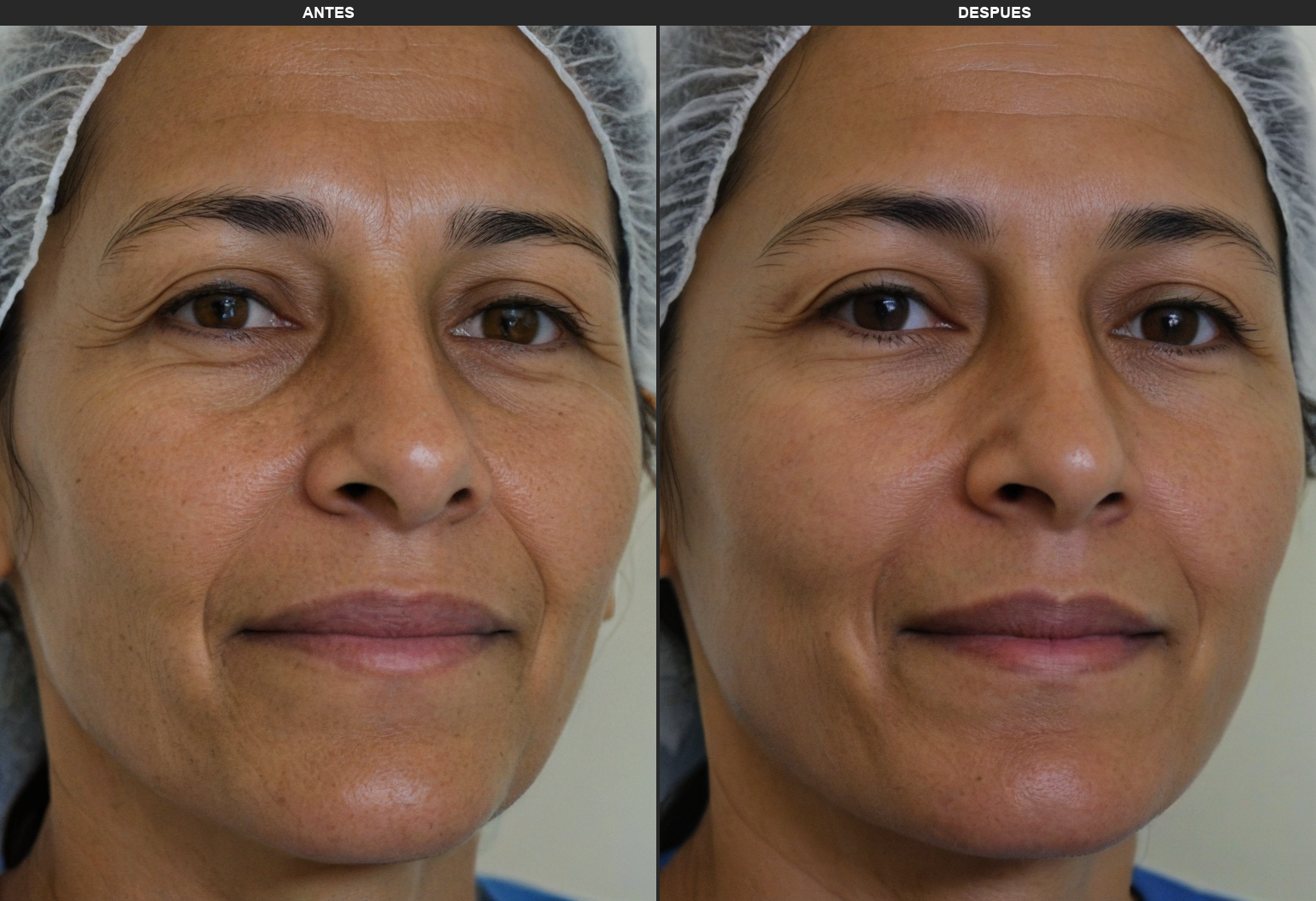 Resultados Ultraformer - Antes y Después