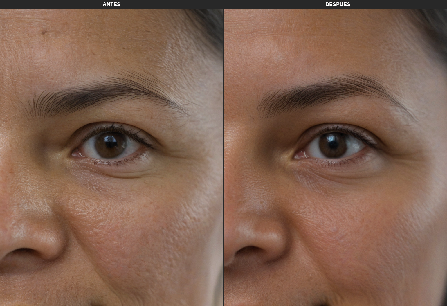 Resultados Ultraformer_Mpt - Antes y Después