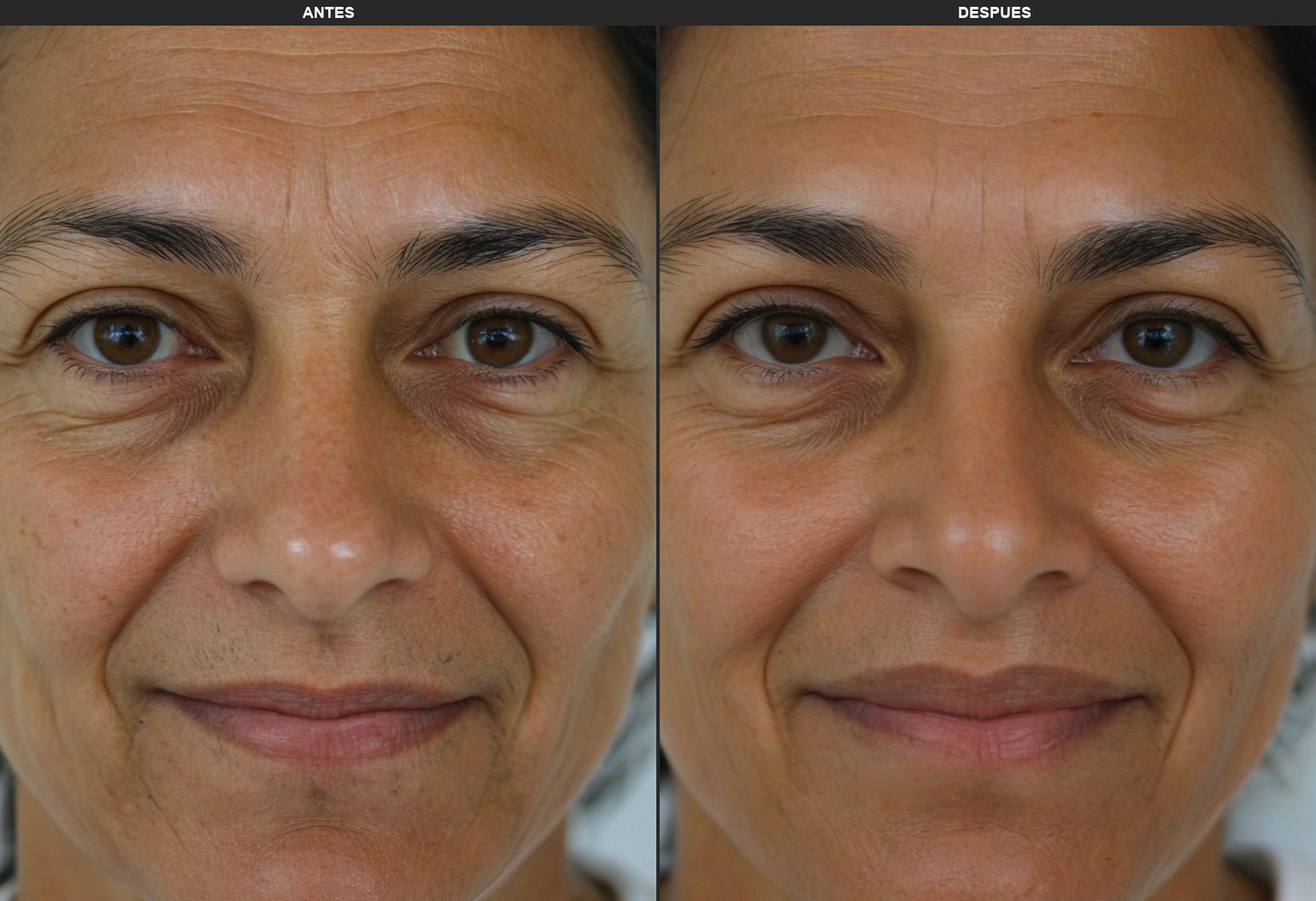 Resultados Ultraformer_Mpt - Antes y Después