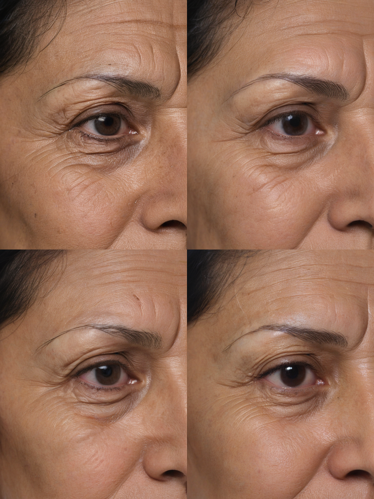 Resultados Ultraformer_Mpt - Antes y Después